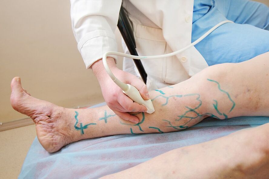 A miniflebectomia előkészítése - jelölés az alsó lábperforátorokon, ultrahangvizsgálat
